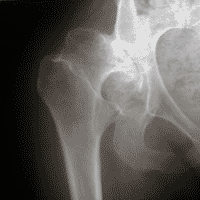 Dysplasia with extrusion