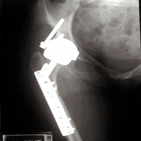 Open reduction, resufacing and femoral derotation osteotomy