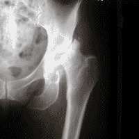 Unusual pattern of hip destruction
