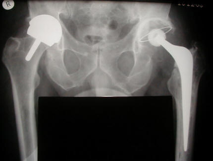 bhrthrdr.bloomfield BHR vs THR X-ray comparing hip resurfacing and a total hip replacment