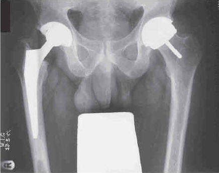 BHR vs THR X-ray comparing hip resurfacing and a total hip replacment