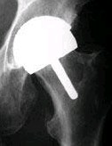 X-ray of BHR in place