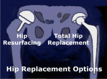 Hip Resurfacing and Total Hip Replacement Illustration by Patricia Walter
