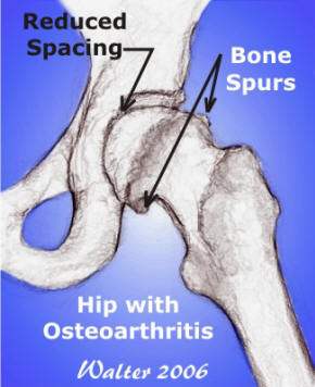 Bone Spurs or osteophytes in hip with osteoarthritis illustration by Patricia Walter