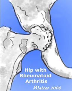 rahipill Osteoarthritis and Rheumatoid Arthritis by Patricia Walter