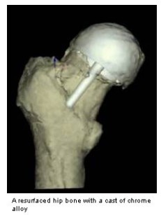 Femur bone with hip resurfacing cap in place