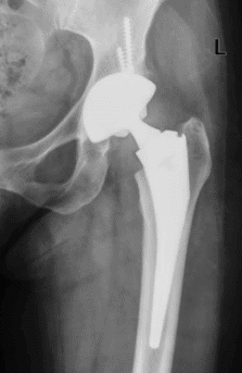 conversion to a total hip replacement