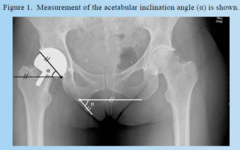 gross angle 1 2012 Refine Intraoperative x-ray technique to routinely achieve an Acetabular inclination angle of less than 50 degrees by Dr. Gross 2012
