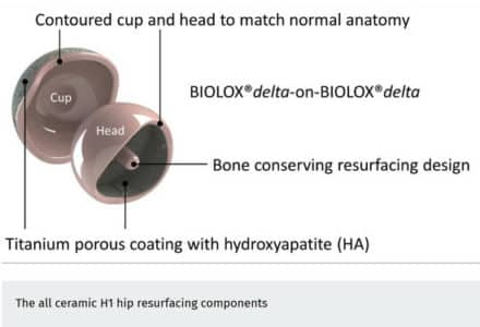 h1 ceramic on ceramic study 2017 Professor Cobb Interview About Hip Resurfacing and the Future of Hip Resurfacing