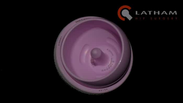 Mr. Jeremy Latham Discusses the ReCerf Ceramic on Ceramic Hip Resurfacing