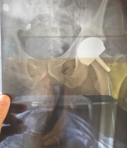Gary O'Neil Hip Resurfacing by Professor Julien Girard 2019 x-ray