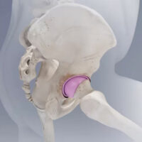 H1 ceramic on ceramic hip resurfacing device, hip resurfacing, hip surgery H1 Ceramic on Ceramic Hip Resurfacing Implant Used by Cleveland Clinic London H1 Ceramic on Ceramic Hip Resurfacing Device by Professor Cobb London