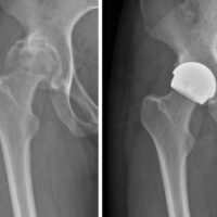 H1 ceramic on ceramic hip resurfacing device, hip resurfacing, hip surgery H1 Ceramic on Ceramic Hip Resurfacing Implant Used by Cleveland Clinic London H1 ceramic on ceramic - before and after surgery