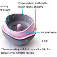 H1 Ceramic on Ceramic Hip Resurfacing Illustration