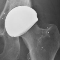 H1 Ceramic on Ceramic Device placed in patient x-ray