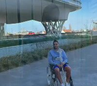 Pritesh Budu Mistry 6 Pritesh Budu Mistry Bilateral ReCerf Hip Resurfacing with Dr. De Smet 2025