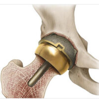 BHR illustration in bone