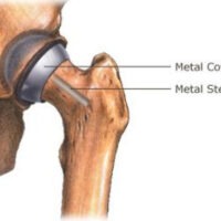 bhr in place sketch Hip Resurfacing Devices Explained