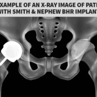 bhr x ray illustration The History of Hip Resurfacing - From Early Failures to Modern Devices