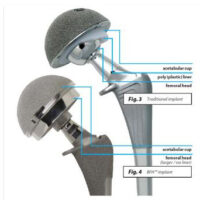 early hip resurfacing