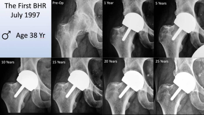 First BHR x-ray from 1997 up to 25 years