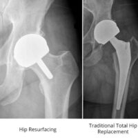 BHR vs THR x-ray - BHR is bone conserving