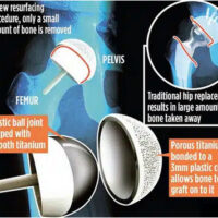 polymotion system 2026 Hip Resurfacing Devices Explained