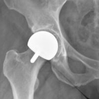 polymotion x ray Hip Resurfacing Devices Explained