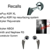 Recalls of defective hip resurfacing devices