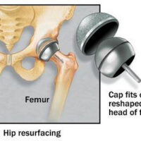 recap sketch installed Hip Resurfacing Devices Explained