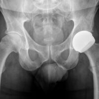 ReCerf x-ray of hip resurfacing device